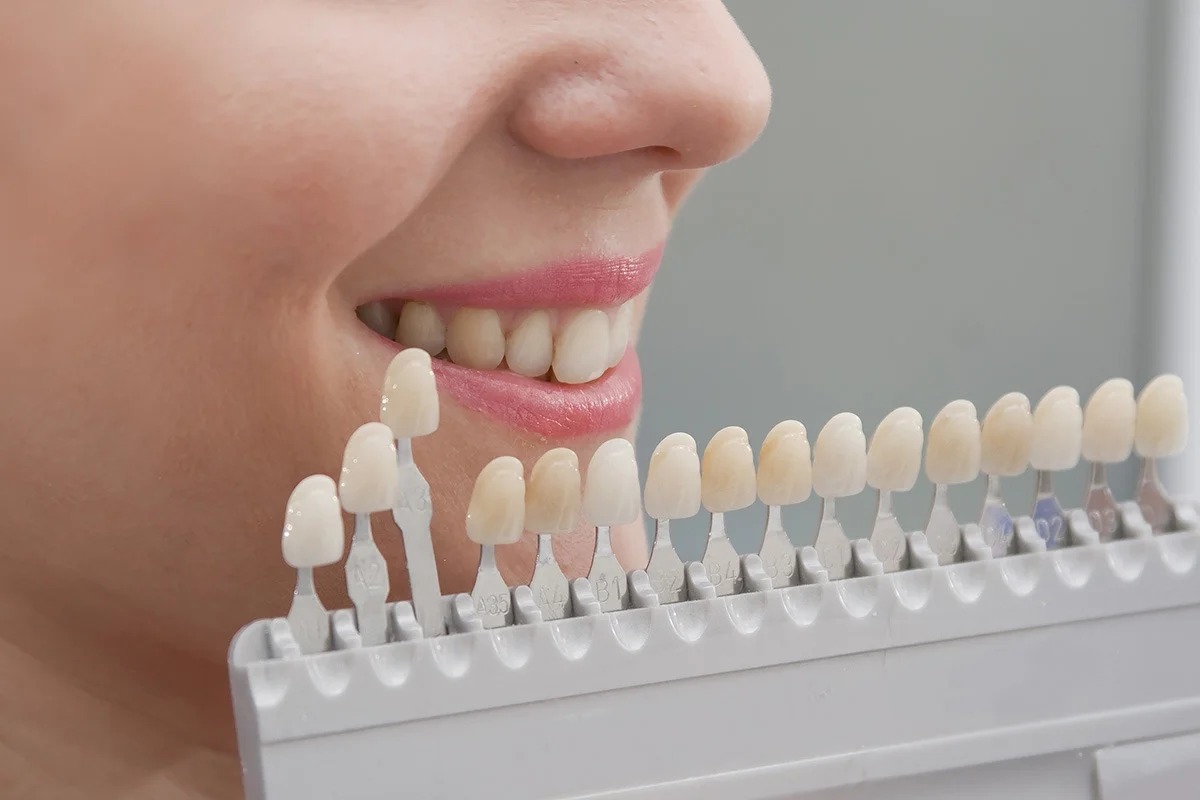 Tooth Colour Filling